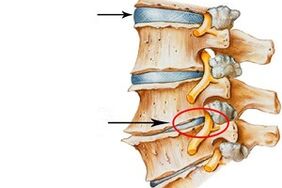 hirudoterapija za bolove u zglobovima bol u zglobu koljena kako liječiti