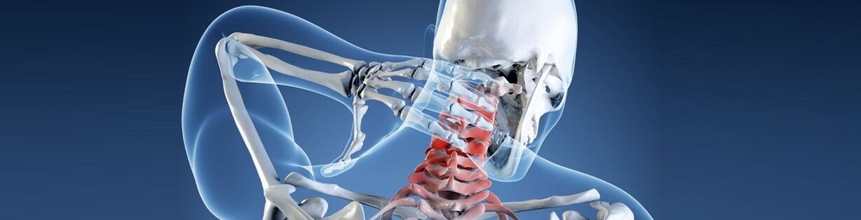 Osteohondroza ljudske vratne kralježnice