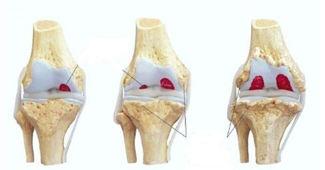 faze artroze zgloba koljena