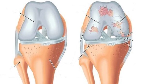 zdrav zglob i artroza zgloba koljena