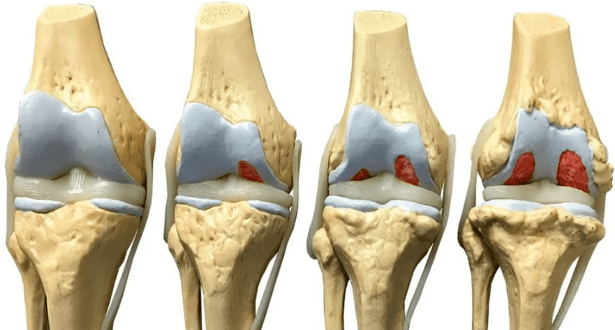 oštećenja zgloba koljena u različitim fazama razvoja artroze