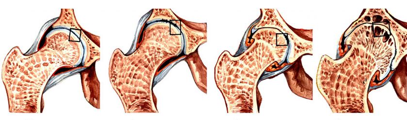 Stupanj razvoja artroze zgloba kuka
