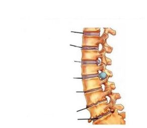 Simptomi osteohondroze