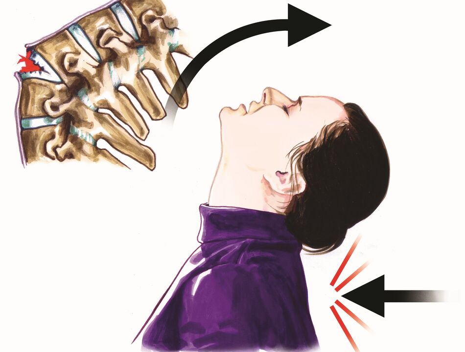 oštećenje kralježnice kao uzrok boli u vratu