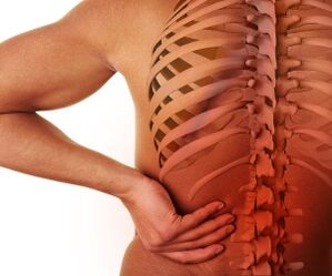 bol u leđima s lumbalnom osteohondrozom