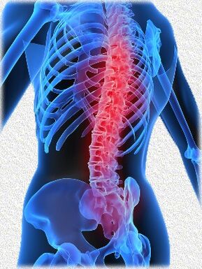 osteohondroza i metode njezina liječenja